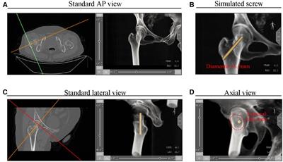 A new posterosuperior screw placement strategy to avoid in-out-in screws in femoral neck fractures